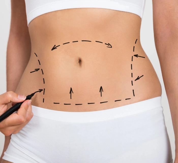 Close-up of a woman's torso with dashed lines and arrows drawn on her skin, indicating areas for potential cosmetic surgery. A hand is holding a marker near her lower abdomen.