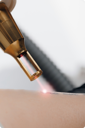 Tattoo Removal Image