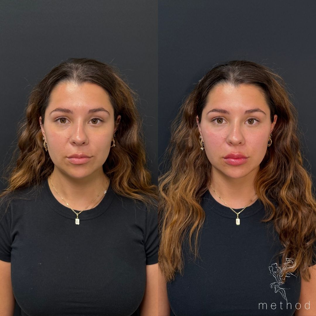 Dermal Fillers 1 Marge Image