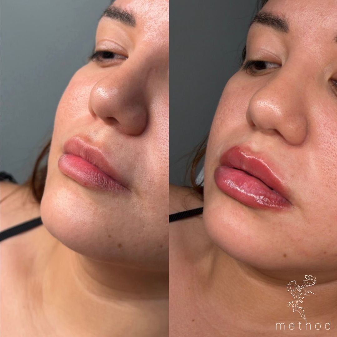 Lip Filler 1 Marge Image