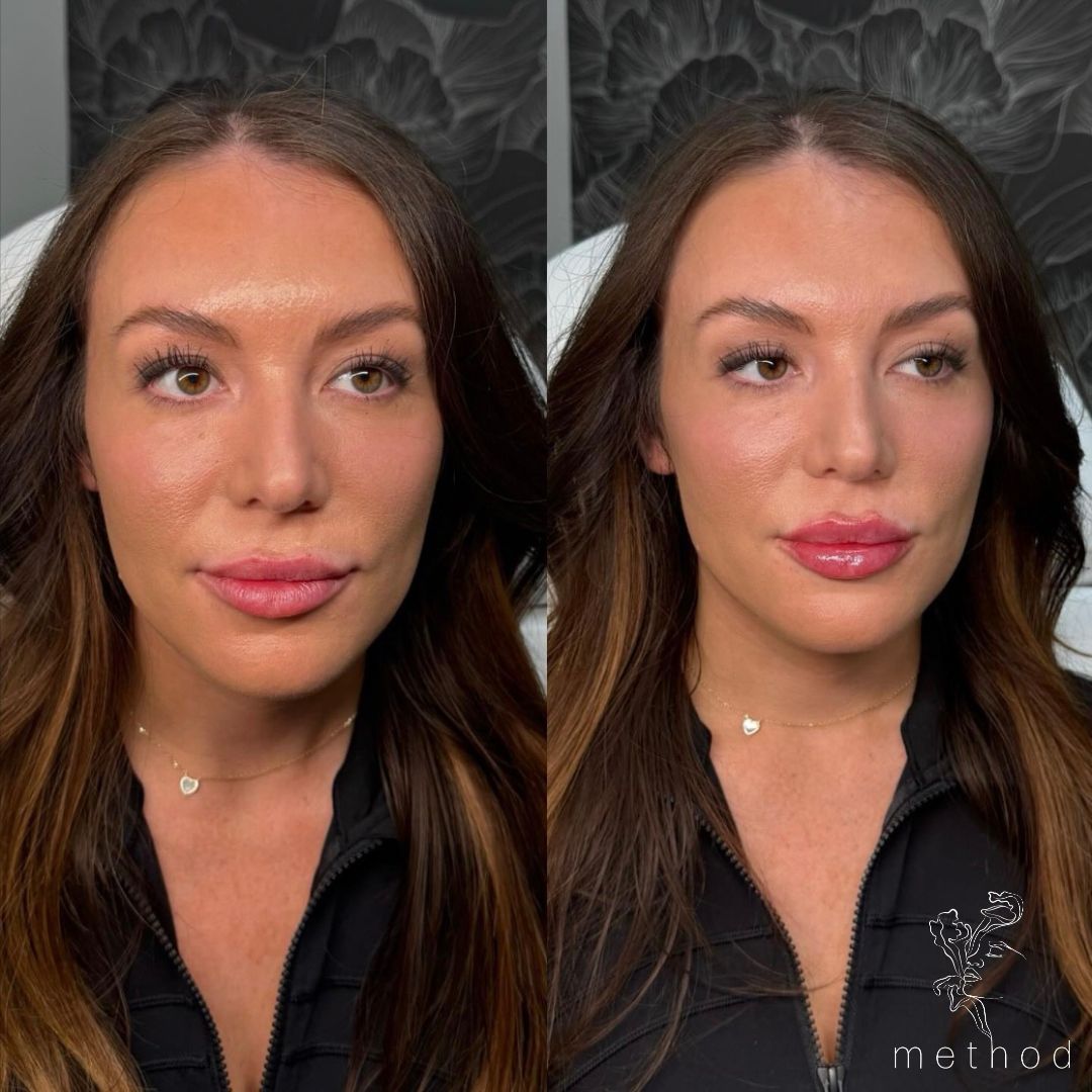Lip Filler 4 Marge Image