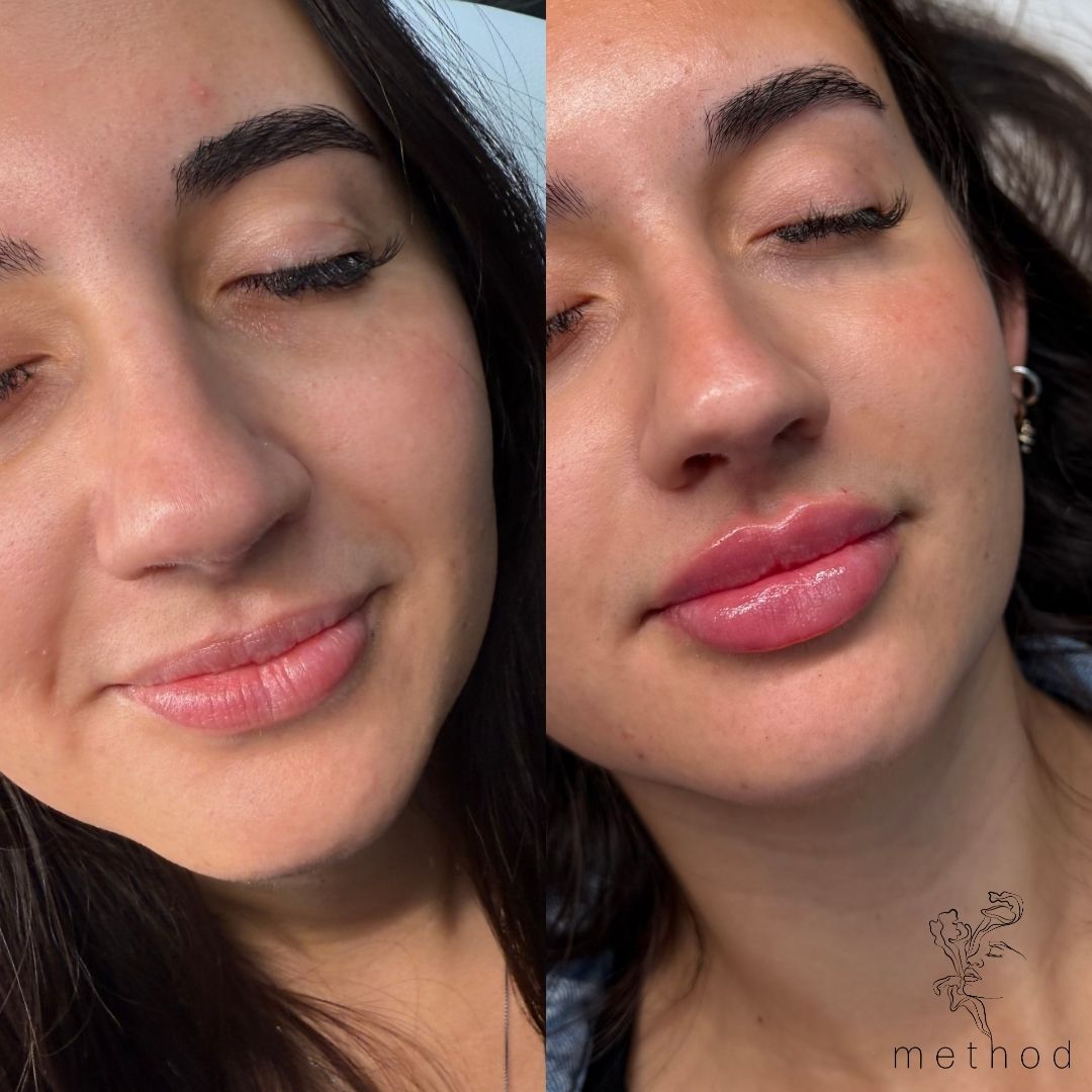 Lip Filler 3 Marge Image