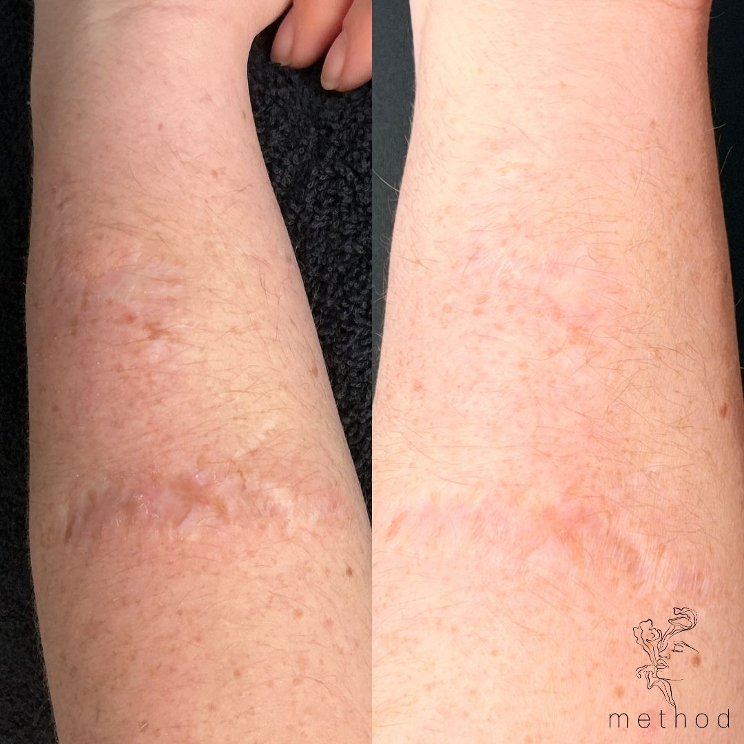 EndyMed Scar Revision 1 Marge Image