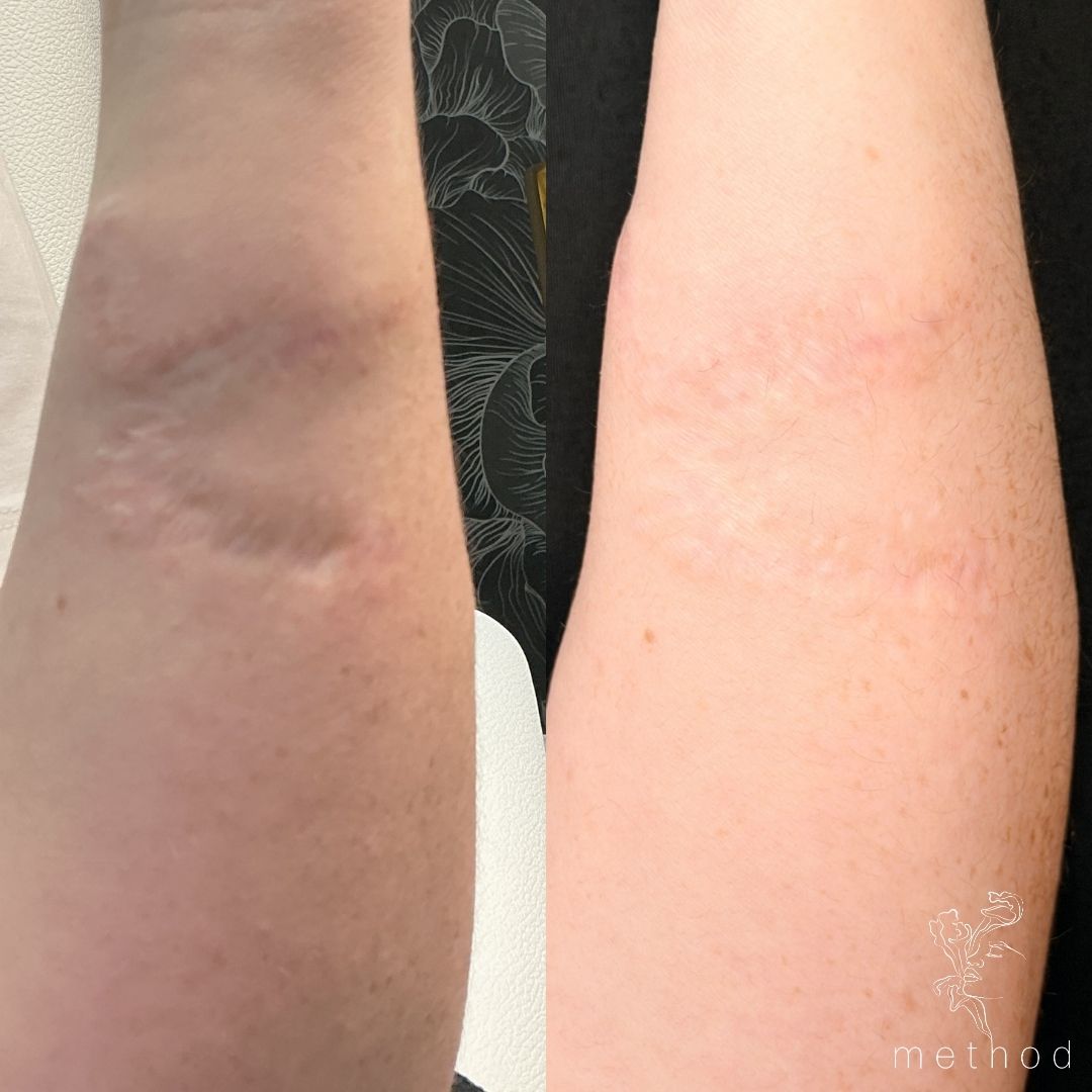 EndyMed Scar Revision 2 Marge Image